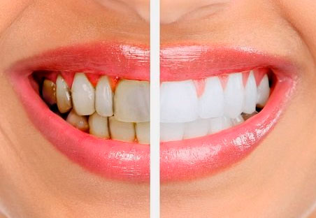 instant white teeth